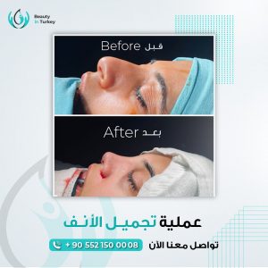 Rhinoplasty in Turkey